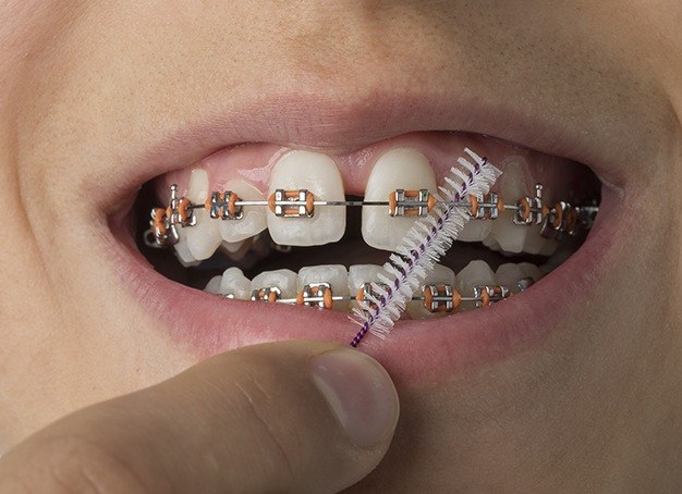 Braces Vs Invisalign : How much do braces treatment cost