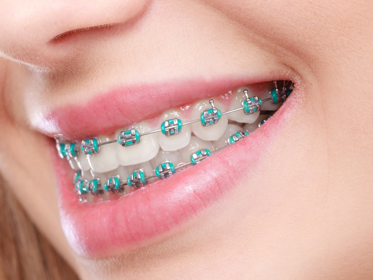 braces-loose-teeth-parsippany-rauchberg-dental-group