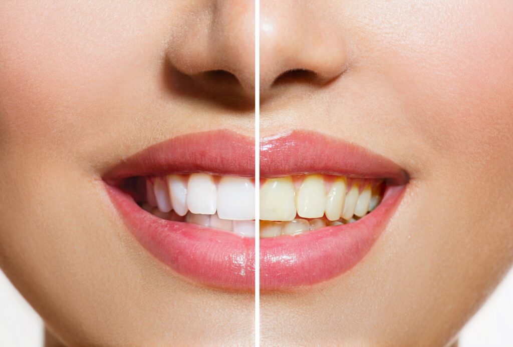 Nose-to-chin view of woman with pink lip gloss smiling to show teeth before and after cosmetic work