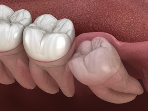 Illustration of wisdom tooth trapped under the gums