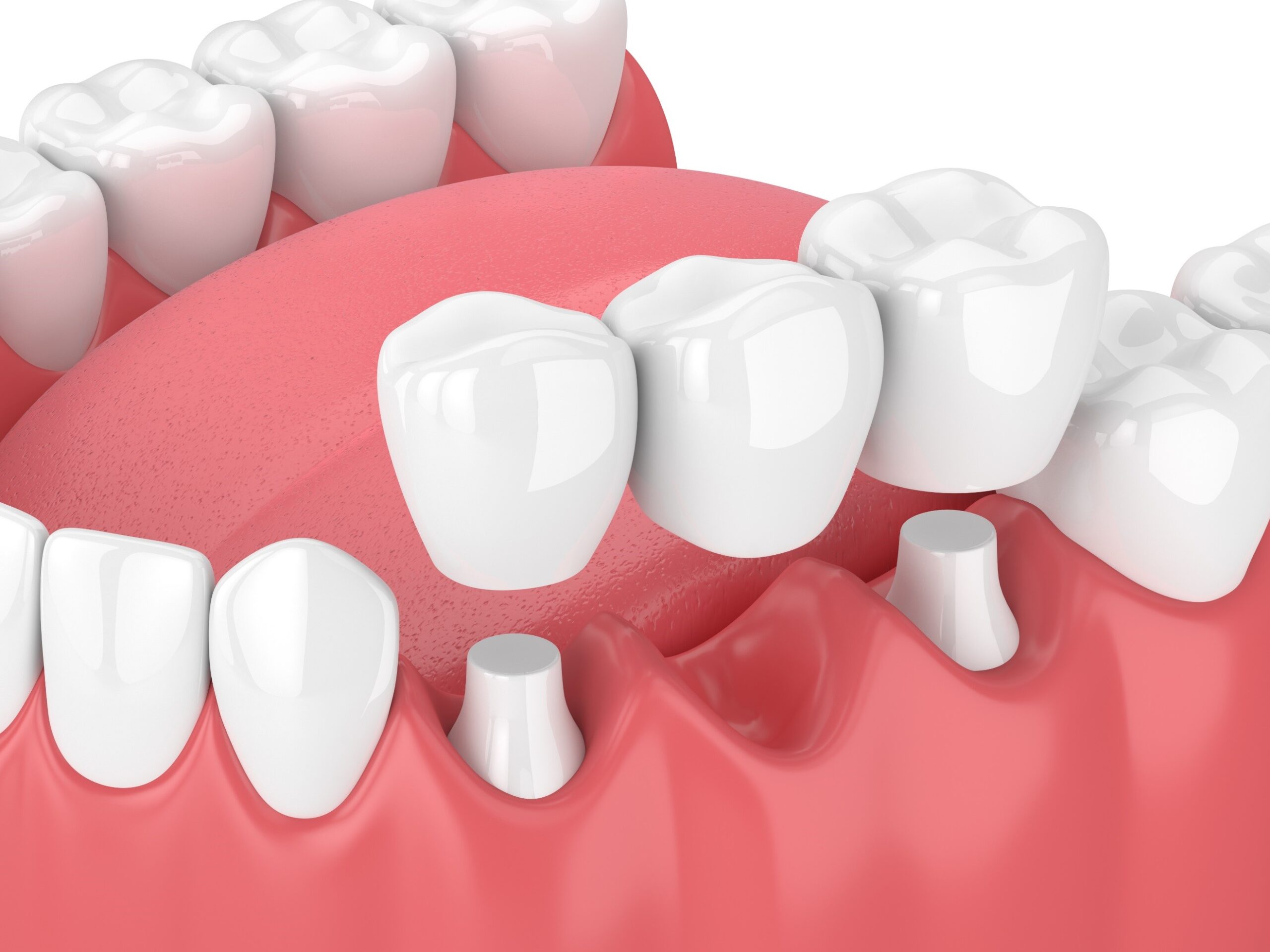 Digital model of dental bridge and crowns for lower teeth