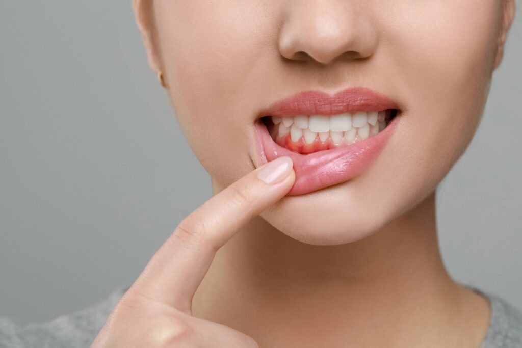 Nose-down view of woman pulling down lip to reveal soft red gums